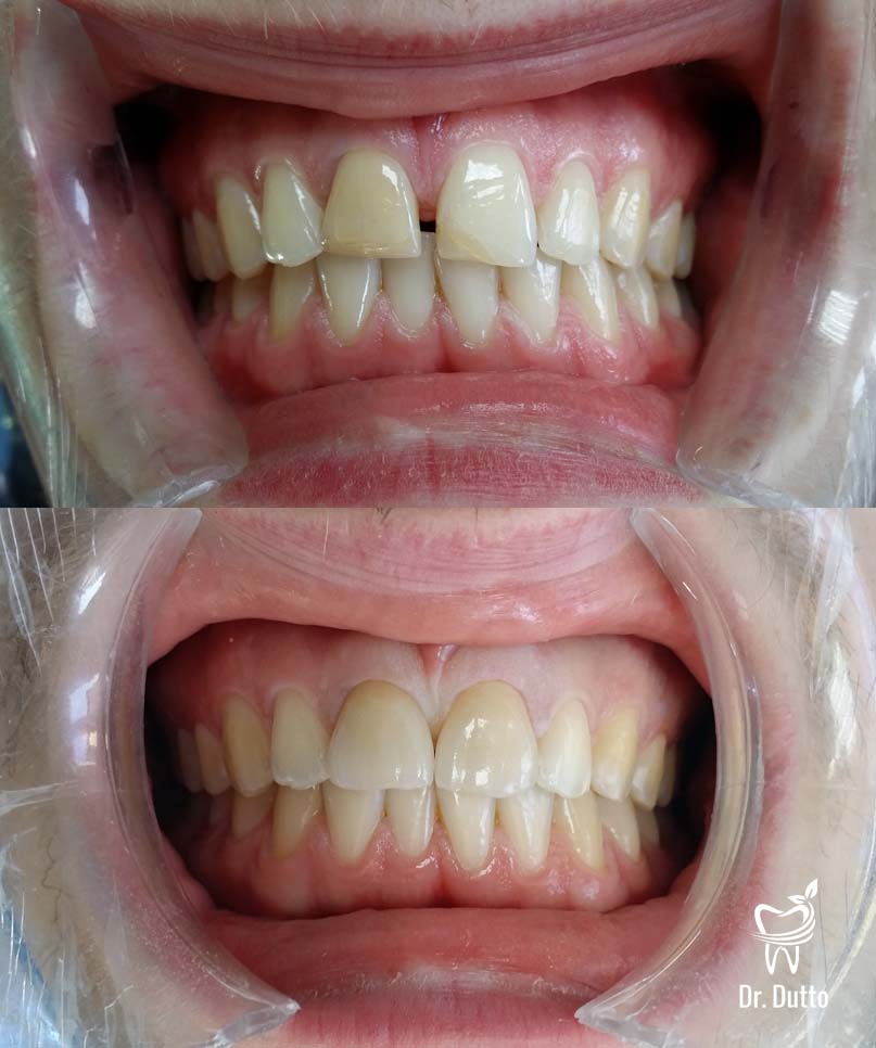 couronnes dentaires avant après exemple 2
